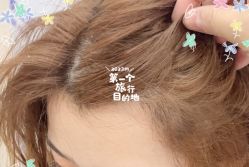 -大麦微针植发全国连锁