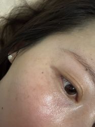 -爱莎扁平疣·汗管瘤·斑痣中心