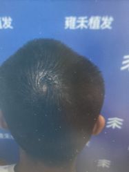 -雍禾植发全国连锁