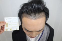 点击看大图 -大麦微针植发丨全国连锁