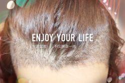 -大麦微针植发全国连锁