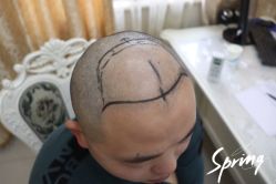 -大麦微针植发全国连锁