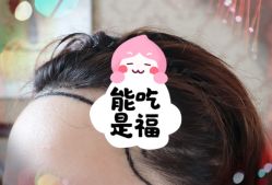 -大麦微针植发全国连锁