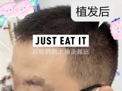 -大麦微针植发全国连锁