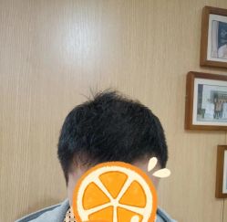 -大麦微针植发丨全国连锁