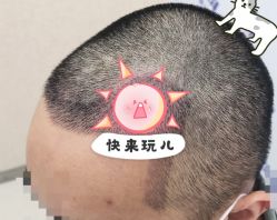 -大麦微针植发全国连锁