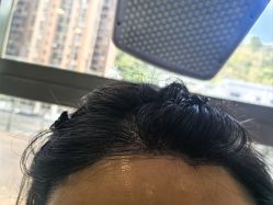 -碧莲盛·不剃发植发