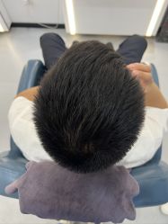 -大麦微针植发全国连锁