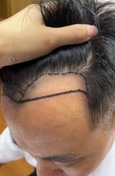 -大麦微针植发全国连锁