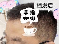 -大麦微针植发全国连锁