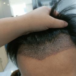 -大麦微针植发丨全国连锁