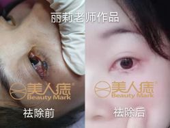 -美人痣全国连锁