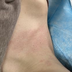 -爱莎扁平疣·汗管瘤·斑痣中心