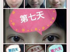 术后七天-上海华安整形外科门诊部