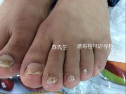 点击看大图 -德哥灰指甲脚气甲沟炎跖疣护理