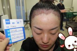 点击看大图 -大麦微针植发丨全国连锁