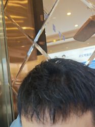 体验后-碧莲盛·不剃发植发