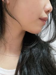 体验前-杭州米兰柏羽医疗美容医院