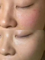 -爱莎扁平疣·汗管瘤·斑痣中心