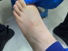 -祖传修脚甲沟炎灰指甲鸡眼
