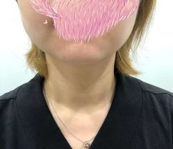 -More摩尔医美の注射线雕光电中心
