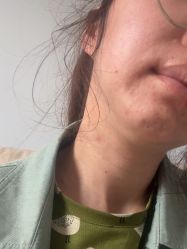体验后-颜蕾医美黄金微针水光美肤玻尿酸抗衰中心