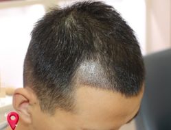 -大麦微针植发丨全国连锁