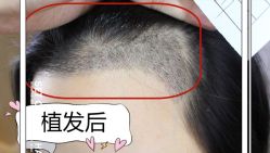 -大麦微针植发全国连锁