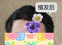 -大麦微针植发全国连锁