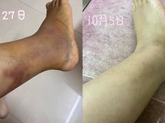 -广州中医药大学第三附属医院(骨伤科分院)