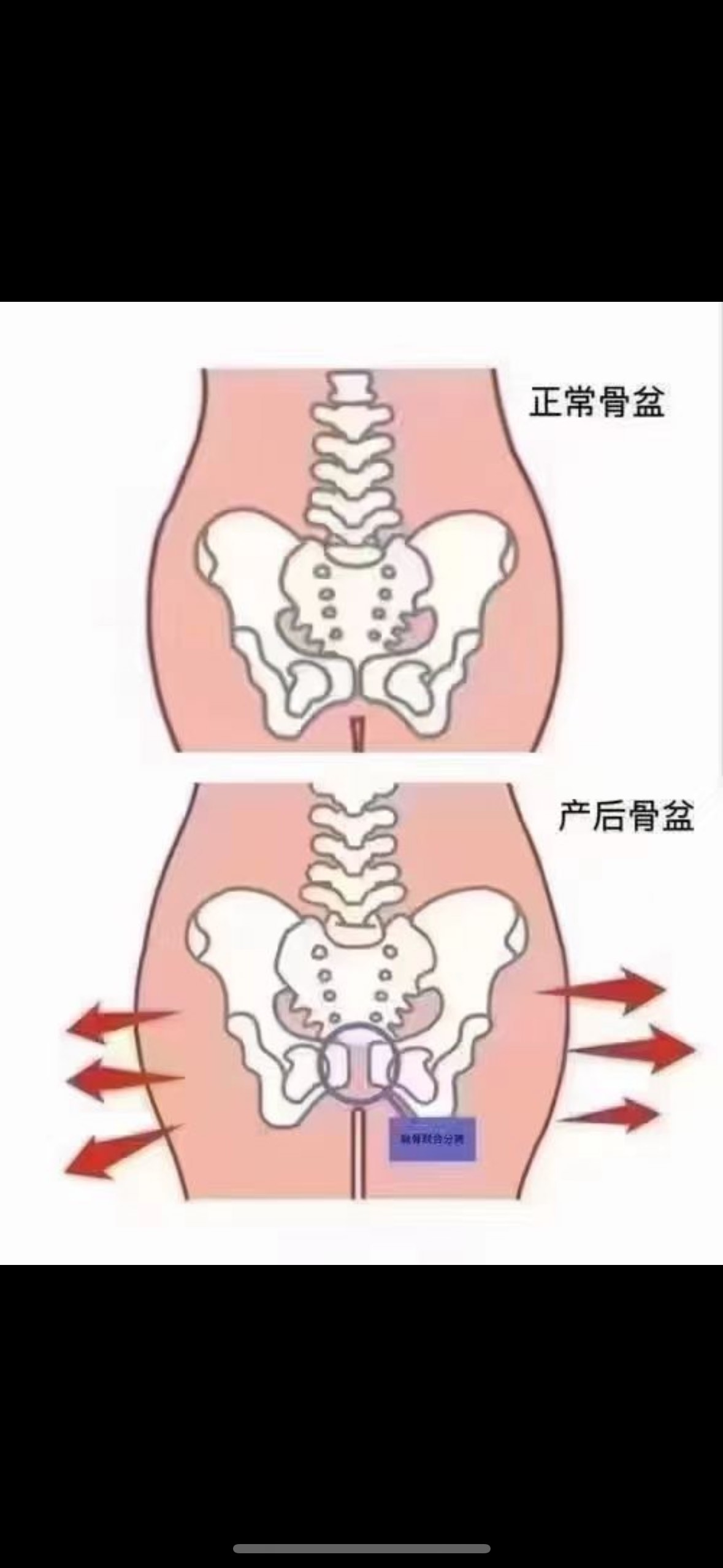 盆骨宽怎么变窄图片