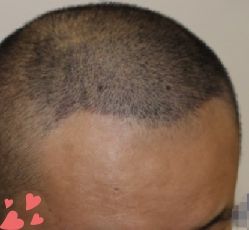 -大麦微针植发丨全国连锁