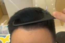 -大麦微针植发丨全国连锁