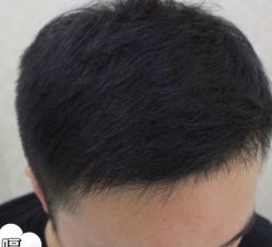 -大麦微针植发丨全国连锁