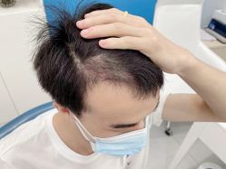 -大麦微针植发全国连锁