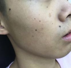 -痣斑堂·取大痣