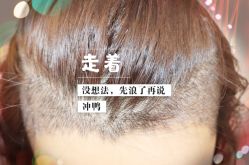 -大麦微针植发全国连锁