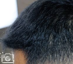 -大麦微针植发丨全国连锁