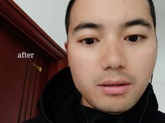 -黑马眼科·近视手术