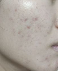 -苗方清颜痘肌研究所