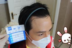 -大麦微针植发丨全国连锁