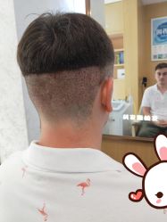 点击看大图 -大麦微针植发丨全国连锁