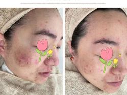 点击看大图 -苗方清颜痘肌研究所