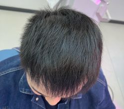-大麦微针植发全国连锁