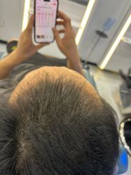 -大麦微针植发全国连锁