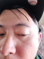 -爱莎扁平疣·汗管瘤·斑痣中心