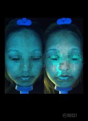 点击看大图 -靓芙泉专研痘痘肌