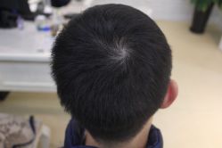 点击看大图 -大麦微针植发丨全国连锁