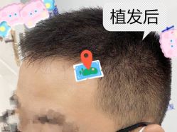 -大麦微针植发全国连锁