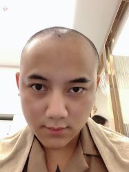 点击看大图 -大麦微针植发全国连锁
